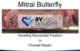 Mitral Butterfly