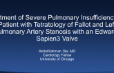 Treatment of Severe Pulmonary Insufficiency in a Patient With Tetralogy of Fallot and Left Pulmonary Artery Stenosis With an Edwards Sapien3 Valve