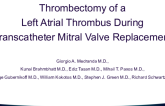 Thrombectomy of a  Left Atrial Thrombus During  Transcatheter Mitral Valve Replacement