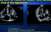 When NOT to TREAT a Patient With Severe TR – Ends of the Spectrum