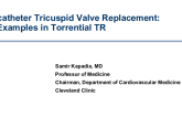Transcatheter Tricuspid Valve Replacement: Case Examples in Torrential TR
