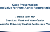 Case: JenaValve for Pure Aortic Regurgitation