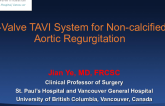 Case: J-Valve for Pure Aortic Regurgitation