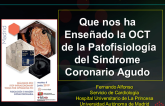 OCT  de la Patofisiología del Síndrome Coronario Agudo