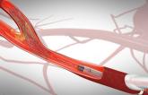 TCAR Use Growing for Carotid Stenosis as Positive Data Continue to Accumulate