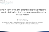 Use of a New-Generation Transcatheter Heart Valve Facilitating Valve-in-Valve TAVR and Bioprosthetic Valve Fracture in a Patient at High Risk of Coronary Obstruction
