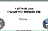 Case 4: A Difficult Case Treated With Tricuspid Clip