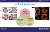 Stent failures – Identifying causes of stent thrombosis and restenosis and how to fix it
