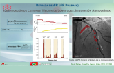 La era de la fisiología coronaria de los índices de reposo: El corregistro de iFR como valor diferenciador a la hora de tratar la descendente anterior