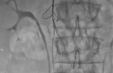 Use of IVC Filters for DVT Peaked in 2010 but Remains High