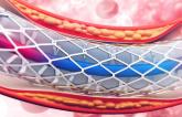 More Acute Stent Thrombosis With Synergy Stent in Bern PCI Registry