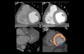 CT Perfusion Imaging for In-Stent Restenosis Shows Promise 
