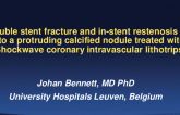 Belgium Presents: Double Stent Fracture and In-Stent Restenosis Due to a Protruding Calcified Nodule Treated With Shockwave Coronary Intravascular Lithotripsy