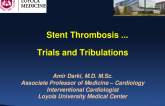 Case Example: Contemporary DES Thrombosis