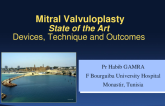 Mitral Valvuloplasty State of the Art: Indications, Devices, Technique, and Outcomes