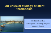Tunisia Presents: An Unusual Etiology of Stent Thrombosis
