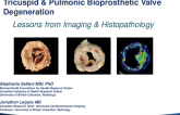 TCT 96: Tricuspid Valve-in-Valve and Bioprosthetic Surgical Tricuspid and Pulmonic Valve Degeneration: Lessons from Imaging and Histopathology