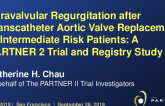 TCT 2: Paravalvular Regurgitation after Transcatheter Aortic Valve Replacement in Moderate Risk Patients: A Pooled PARTNER 2 Trial and Registry Study