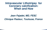 Intravascular Lithotripsy for Coronary Calcification: When and How
