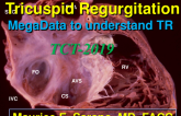 Using Mega-Data to Understand Tricuspid Valve Disease