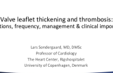Valve Leaflet Thickening and Thrombosis: Definitions, Frequency, Management, and Clinical Importance