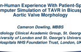 Featured Technological Trends - Fascinating Lecture: First-in-Human Experience With Patient-Specific Computer Simulation of TAVR in Bicuspid Aortic Valve Morphology