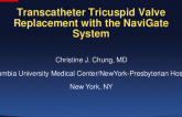 Case-Based Heart Team Presentations - Case #3: Transcatheter Tricuspid Therapy for Severe TR