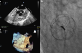 Better Closure, More A-fib With Cardioform for PFO Closure: Retrospective Series