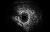 IVUS-XPL at 5 Years Shows Durability of Imaging Guidance in PCI