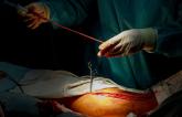 DAPT Cuts Saphenous Vein Graft Failure After CABG: Meta-analysis