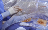 AMBULATE: Venous Closure Device Pays Off After Catheter Ablation