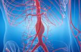 Uproar Continues Over UK NICE Guidelines Restricting EVAR for AAA