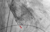 Optimal Implantation Depth With Self-Expanding TAVR? Success May Prove Elusive 