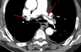Overuse of CT Scans for Suspected Pulmonary Embolism Persists