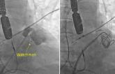 Embolization Coils May Be an Option for Leaks After LAA Occlusion