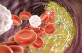 Lp(a) Reduction Contributes to Alirocumab’s Treatment Benefit: ODYSSEY Outcomes