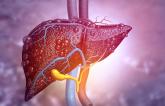 Cirrhosis Tied to Poor Outcomes in the Months After PCI