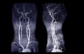 Stroke Thrombectomy for Basilar Artery Occlusions Gains Support: Registry