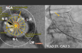Preventing TAVR Obstruction of Coronary Arteries Remains a Challenge