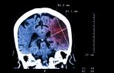 ‘Silent’ Brain Infarcts Common, Tied to Cognitive Decline in A-fib