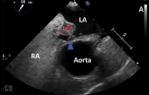 Atrial Septal Aneurysm, Not Shunt Size, Tied to Recurrent PFO-Related Stroke