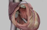 Micra Leadless Pacemaker Tied to Fewer Complications in Medicare Patients