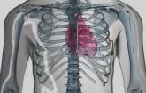 Subcutaneous ICD Holds Up Well Against Transvenous Devices