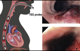 High TEE Injury Rate in Structural Heart Interventions Warrants Caution
