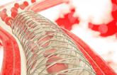 Stent Thrombosis May Be Presenting Feature of COVID-19 