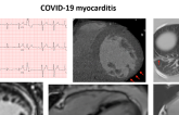 Which Modality and When? New Guidance for Cardiac Imaging in COVID-19 