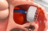 FDA Approves Next-Generation Watchman FLX Device for LAA Occlusion