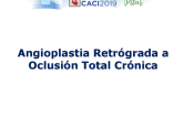 Angioplastia Retrógrada a Oclusión Total Crónica