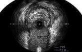 Better Outcomes, Including Mortality, With IVUS-Guided PCI: Medicare Analysis