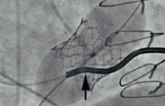 When a Pacemaker Lead Complicates Transcatheter Tricuspid Replacement: New Insights